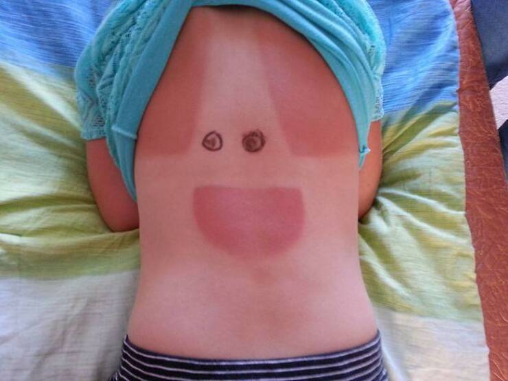 When Sunbathing Goes Wrong…