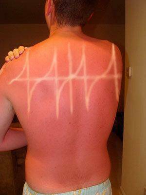 When Sunbathing Goes Wrong…