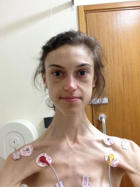 From Anorexia To An Amazing Body!