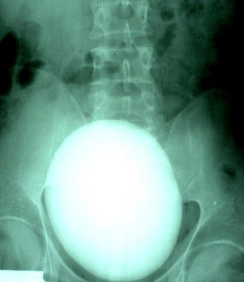 Kidney stone (3 pics) Kidney stone (3 pics)