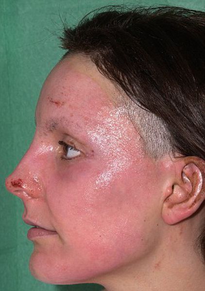 Incredible Healing after a Bomb Explosion (15 pics)