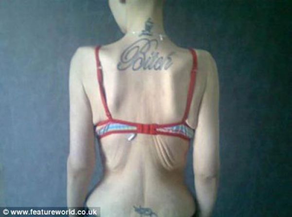 From Fat to Anorexic