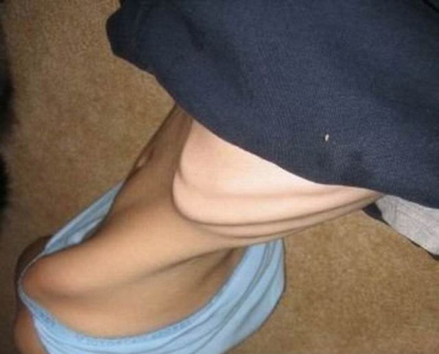 Anorexic Girls