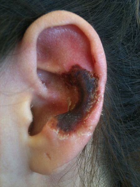 What a Brown Recluse Spider Bite Looks Like