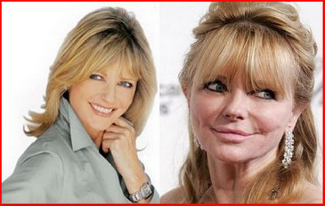 Celebrity Plastic Surgery Before & After