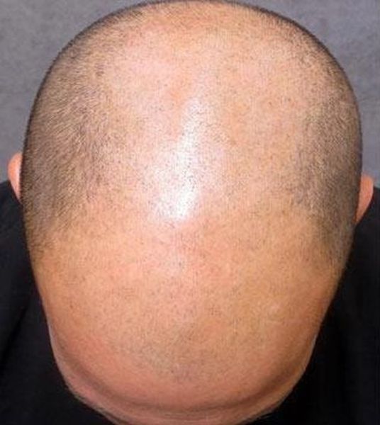 The ‘No Hair’ Solution!