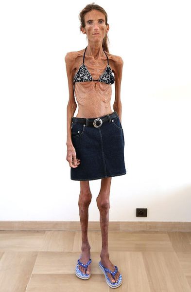 Her Dream Body Is Killing Her