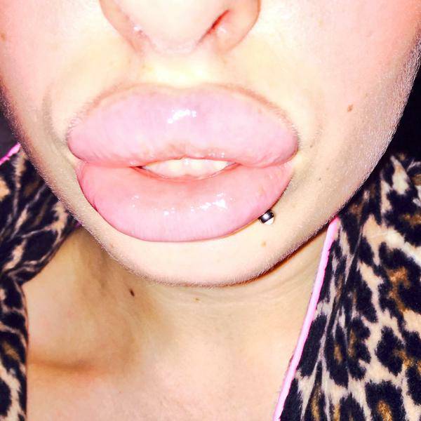 Victim Of The Silicone Injections