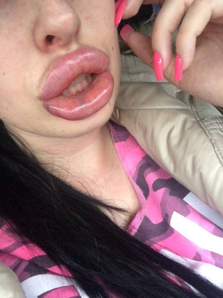 Victim Of The Silicone Injections